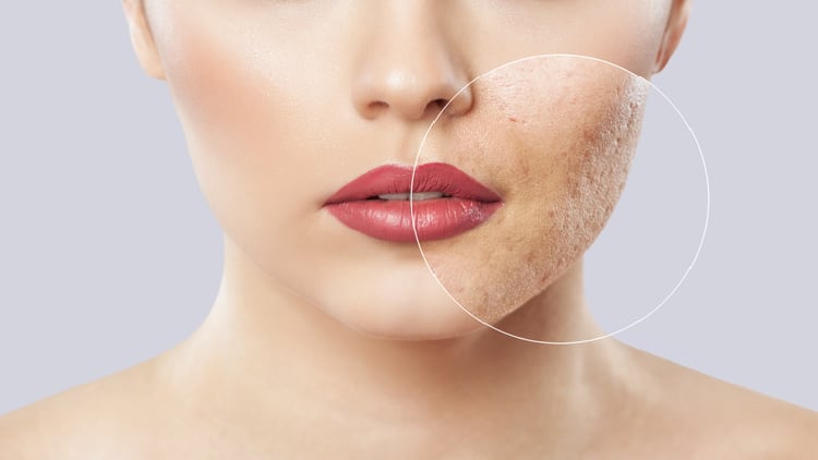 Atopic allergies focus: Practitioner-brand Activated Probiotics to expand range with asthma and acne products