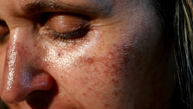 Can supplements protect against UV-induced skin damage?