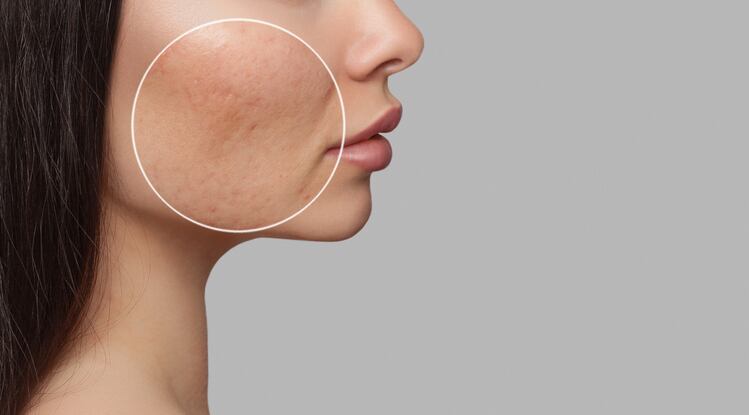 Kimchi-isolated probiotic strain supplementation reduces acne severity – CJ Foods’ 12-week RCT