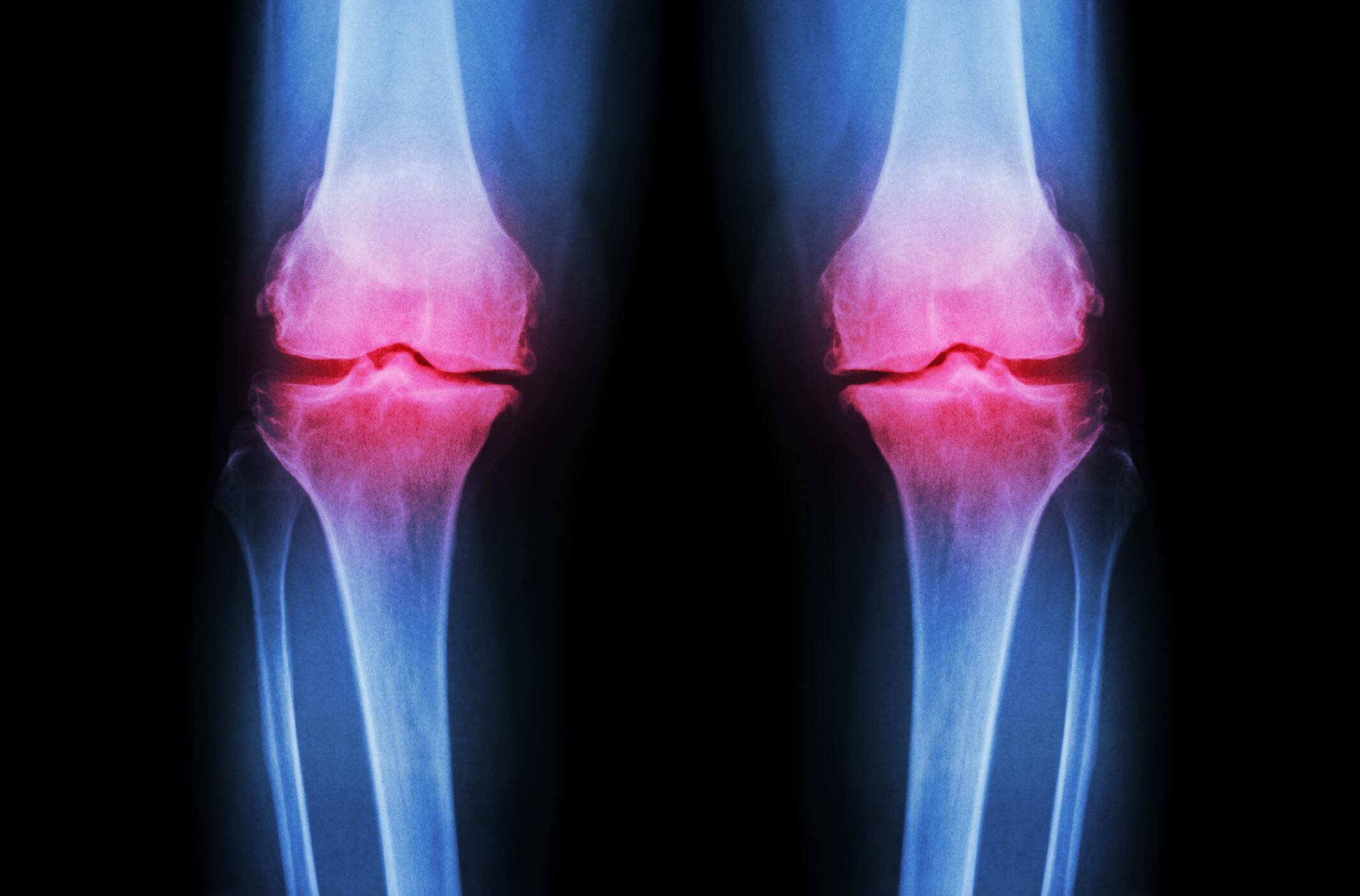 Meta-analysis supports joint health potential of collagen