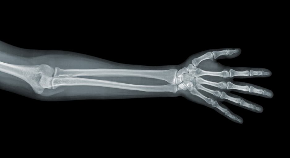 arm-x-ray-bones-calcium-vitamin-D.jpg