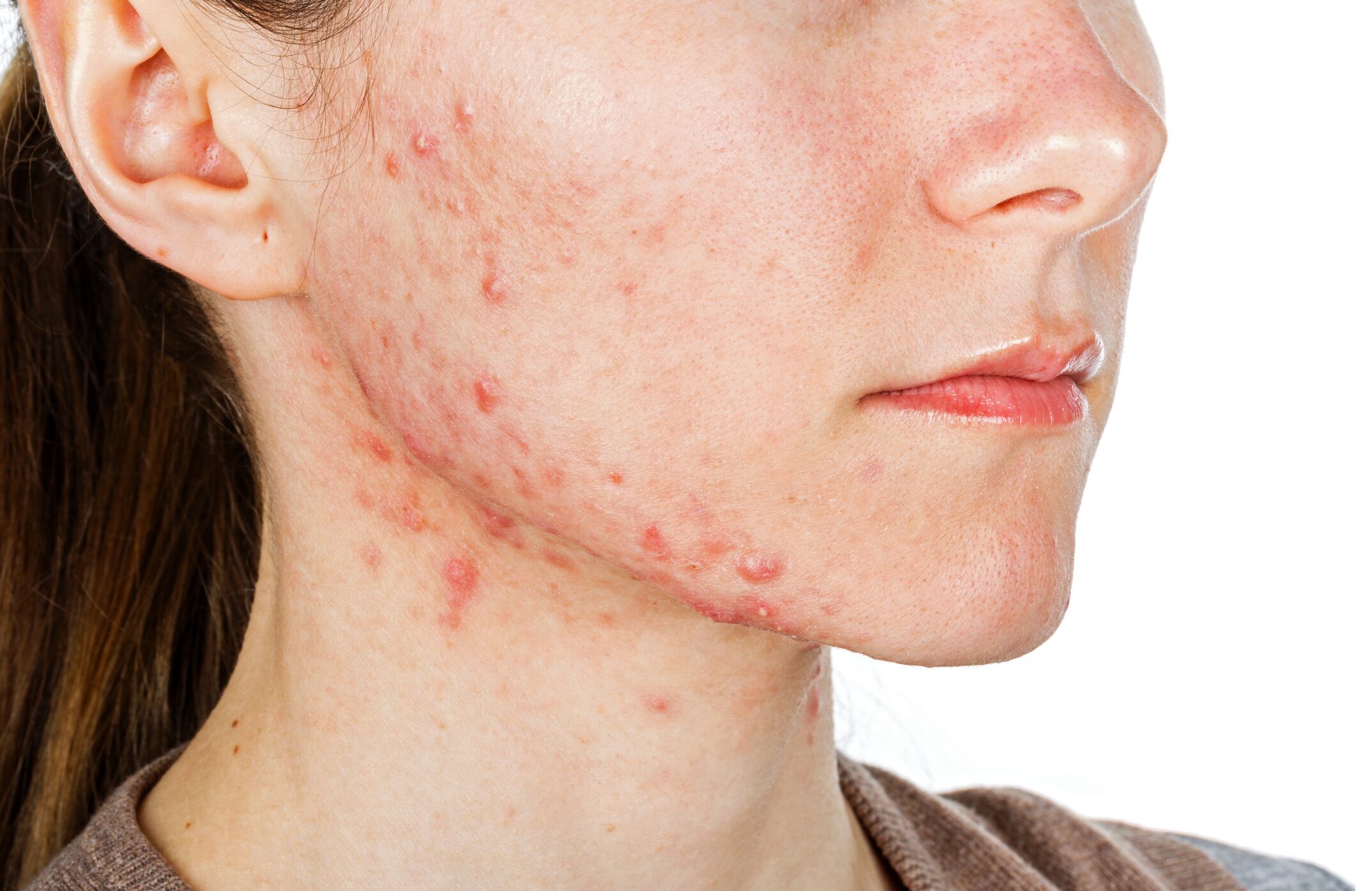 Prebiotic-combination-shows-metabolic-benefits-for-adults-with-acne-Pilot-data.jpg