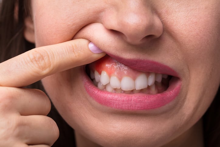 Oral health probiotics NPD: BLIS Technologies explores concepts for pregnant women and chemo patients