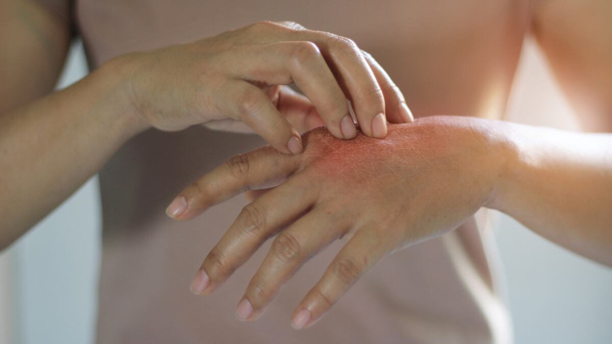 Vitamin D2 supplementation may alleviate psoriasis and slash vitamin D deficiency: Thai RCT