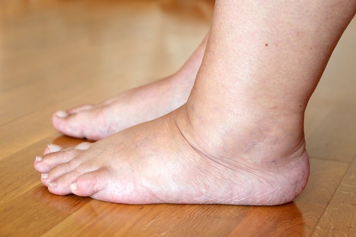 Korean regulator may allow functional ingredient use for leg swelling, intestinal discomfort relief 
