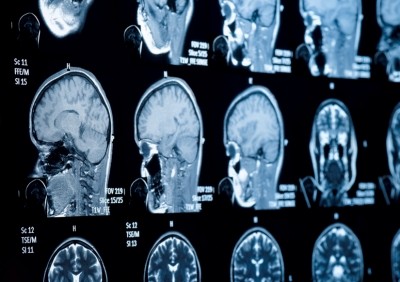 タウリン導入が脳腫瘍に対する光線力学的治療の効果を増大：日本の研究