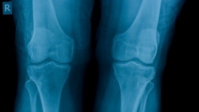 Osteoarthritis is usually treated with non-steroidal anti-inflammatory drugs (NSAIDs). ©iStock