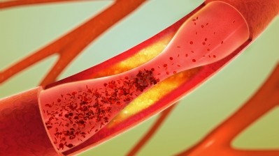 Inflammation and hyperlipidaemia strongly influence the development and progression of atherosclerosis. ©Getty Images