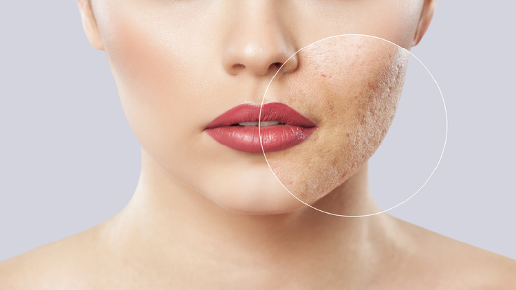 Practitioner-brand Activated Probiotics will be launching a probiotic targeted at acne. ©Getty Images 
