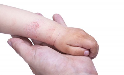 The supplementation of both Lactobacillus and Bifidobacterium during pregnancy could reduce the risk of eczema developing in infants, a meta-analysis has shown. ©Getty Images 