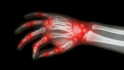 Rheumatoid arthritis and gingival disease are linked both epidemiologically and pathogenically. ©iStock
